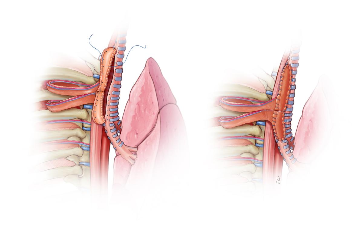 Multidisciplinary Management And Repair Of A Traumatic Posterior